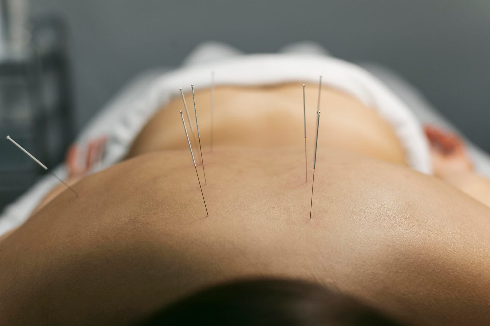 white woman lying on her stomach with acupuncture needles on her back mostly along her spine